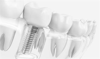 Dental Implants Plantation | Dentist Plantation | Dentist 33323 | Dental Care Of Plantation